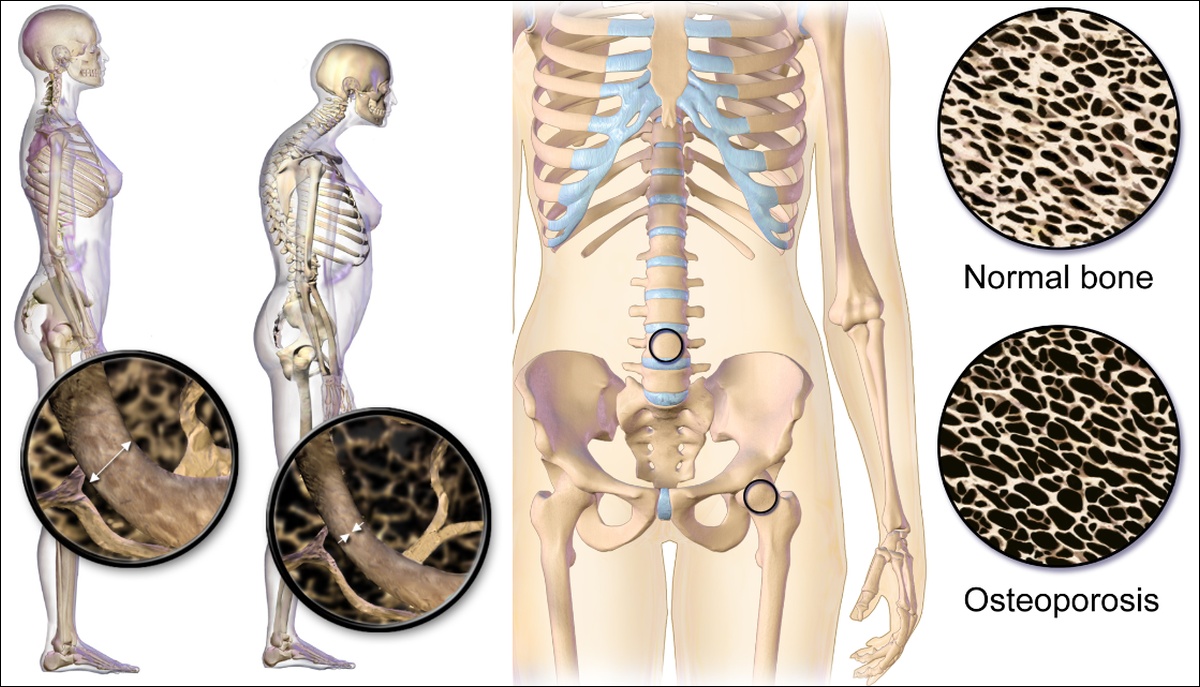 csontritkulas-osteoporosis