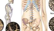 Csontritkulás osteoporosis